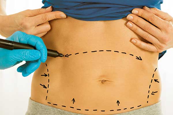 BARIATRIC SURGERY